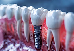 Digital image of dental implant between natural teeth