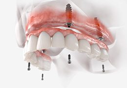 Illustration of implant dentures for upper arch