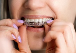 Close-up of woman’s mouth as she places clear aligner on her teeth