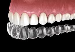 Illustration of clear aligner being used to straighten teeth