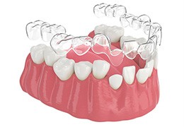 Illustration showing clear aligner being placed on teeth